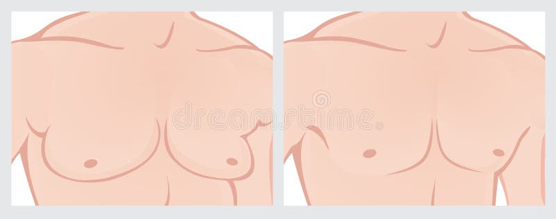 Male chest reduction vector illustration