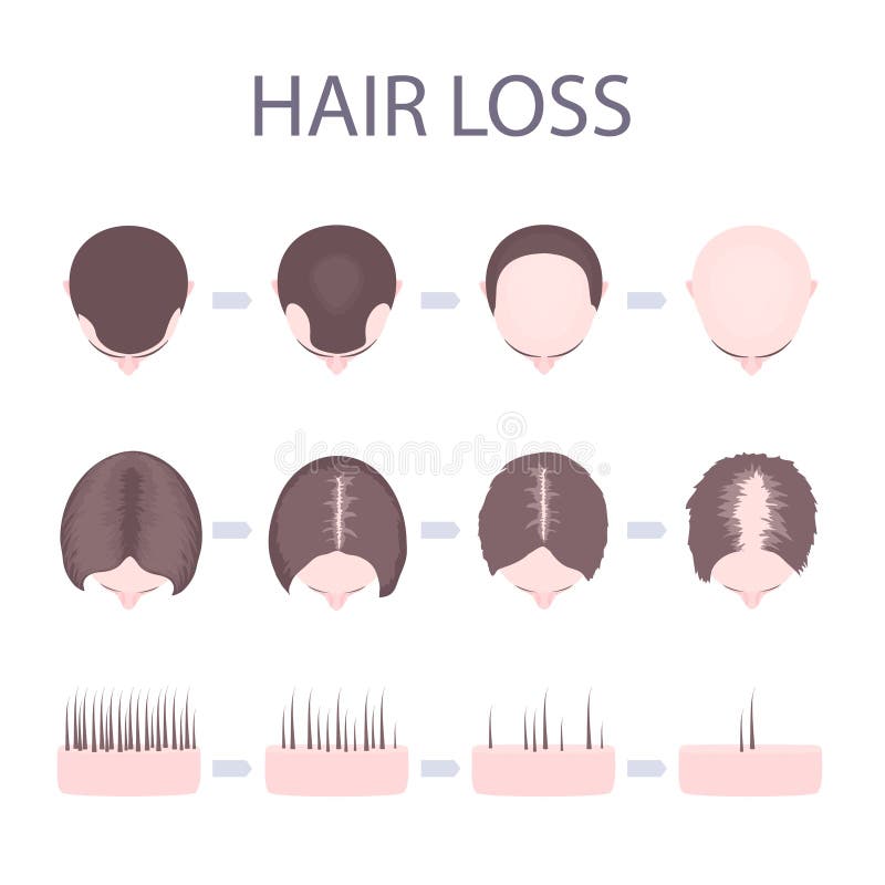 Male and female hair loss stock vector. Illustration of growth - 109960114 Male and female hair loss stock vector. Illustration of growth - 109960114