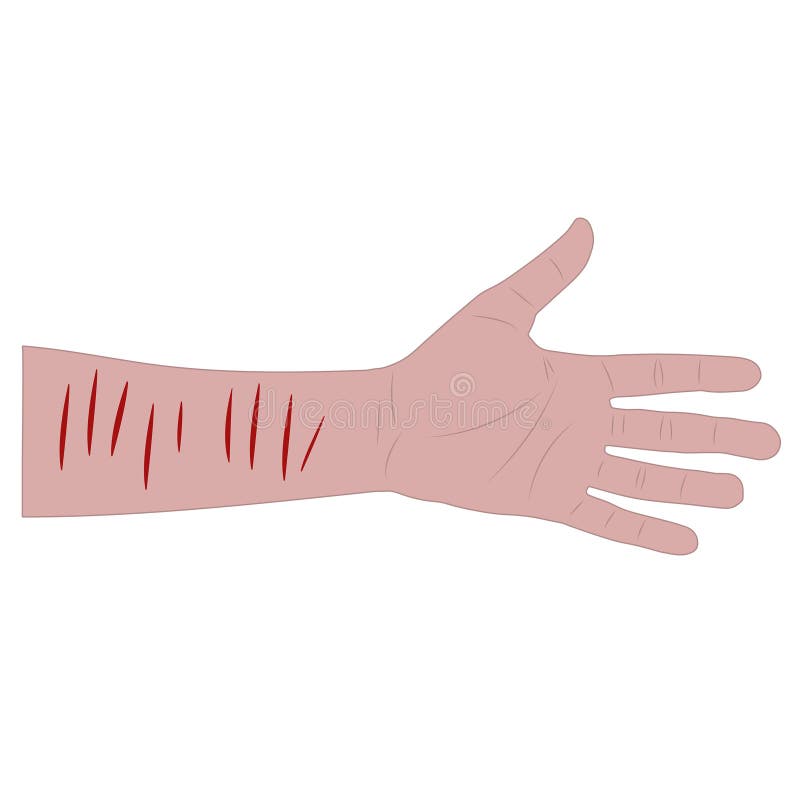 Wrist Cuts Stock Illustrations – 7 Wrist Cuts Stock Illustrations