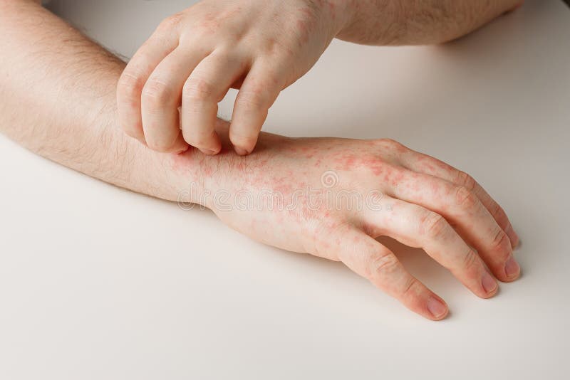 Male Hands Scratching Itchy Red Spots On Skin Allergy Reaction From