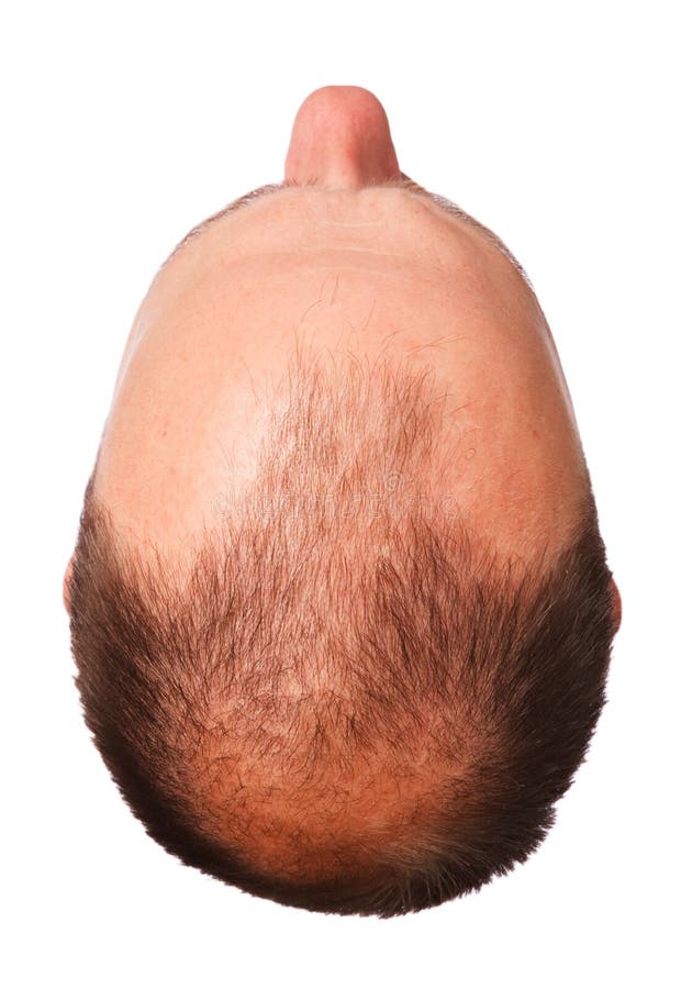 Male pattern baldness stock photo Male pattern baldness stock photo