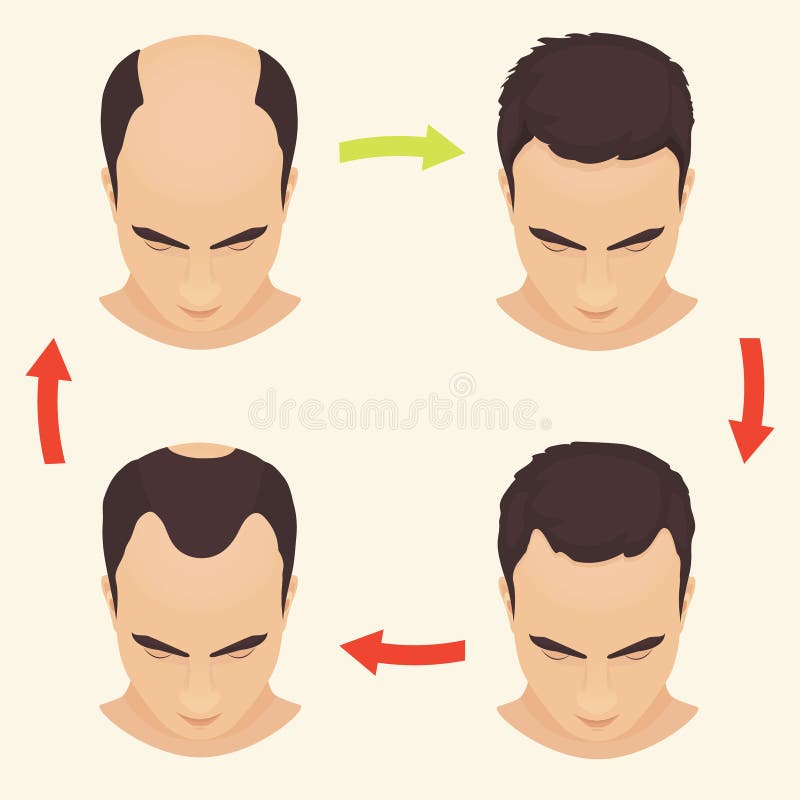 Male pattern baldness set stock illustration. Illustration of grow - 73137012 Male pattern baldness set stock illustration. Illustration of grow - 73137012