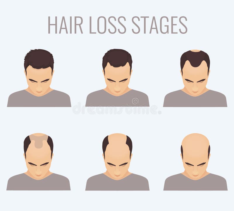 Male Pattern Baldness Stages Stock Illustration - Illustration of head,  male: 73291227