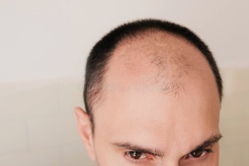 Young man looking at mirror worry about balding