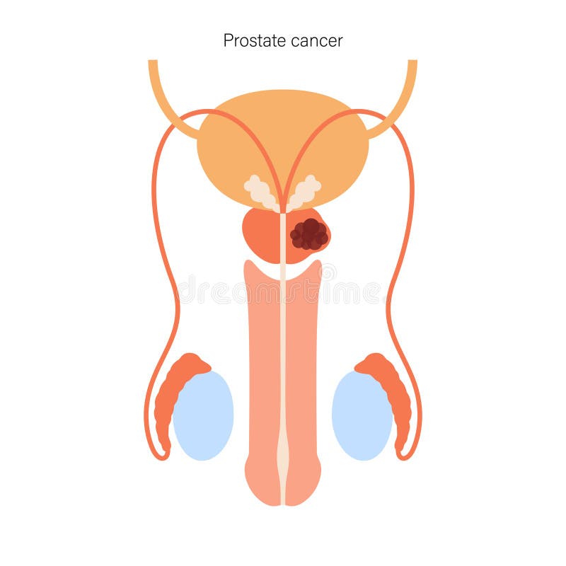 programare pentru prostatită abces de la prostate chez le chien