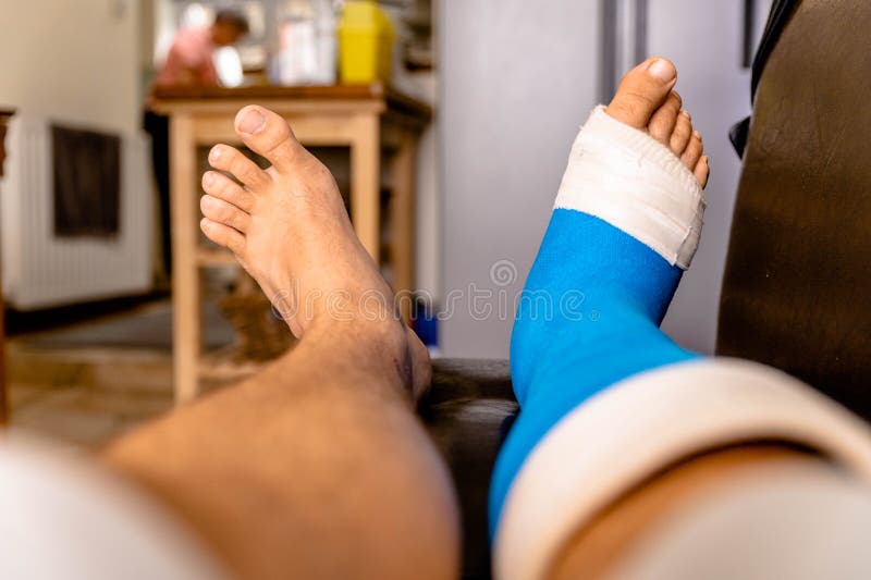 Male Resting Cast on Chair Elevated from Foot Surgery Stock Photo Image of caucasian, medicine