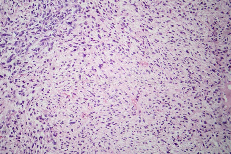 Malignant cells, light micrograph stock photo