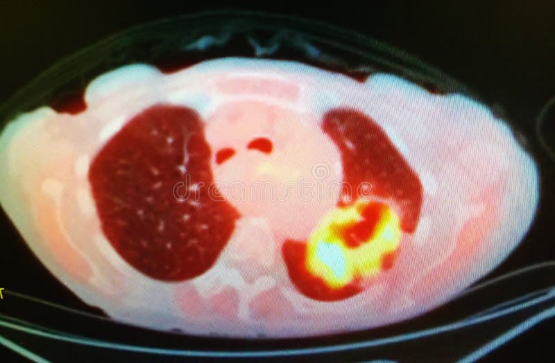 There is PET/CT scan, revealed cavitary mass in the left upper lobe ,consistent with malignancy , which has yellow color on image . There is PET/CT scan, revealed cavitary mass in the left upper lobe ,consistent with malignancy , which has yellow color on image .