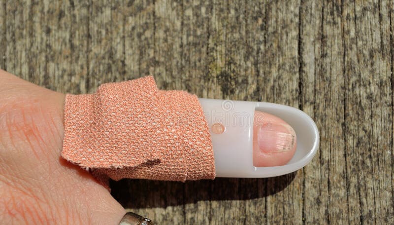 Mallet Finger Splint royalty free stock photography