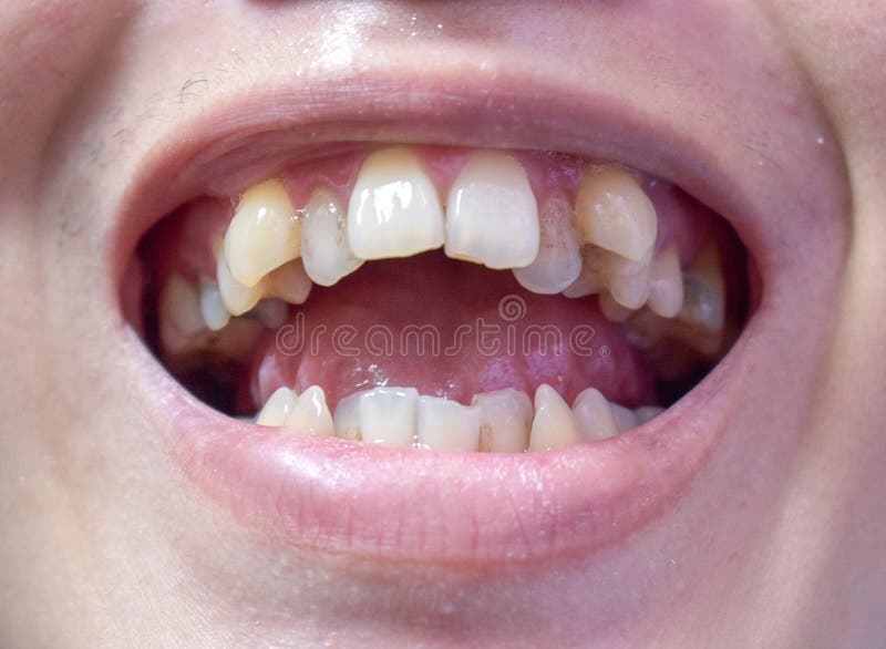 Uneven and yellow stained teeth of both jaws in Asian, Myanmar Man. Uneven and yellow stained teeth of both jaws in Asian, Myanmar Man