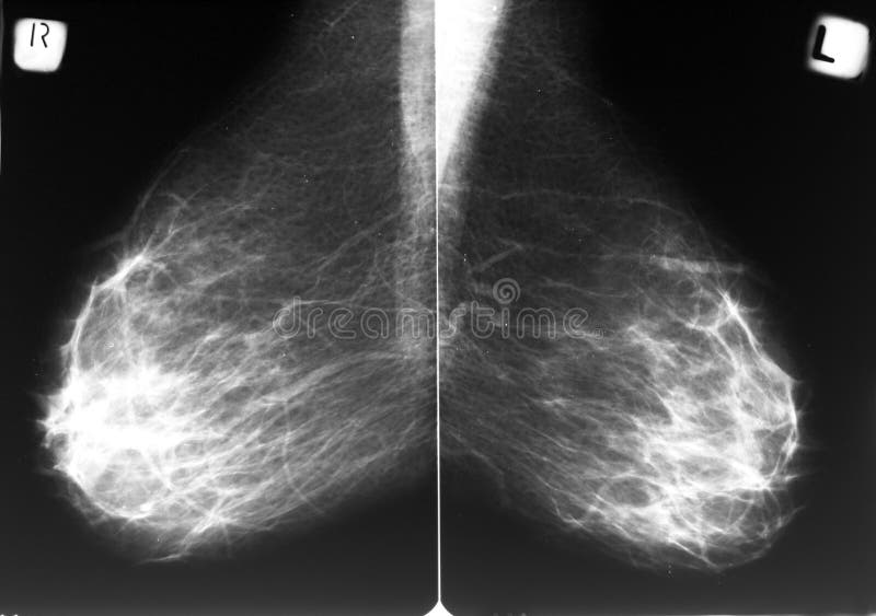 Mammogram stock photo Mammogram stock photo