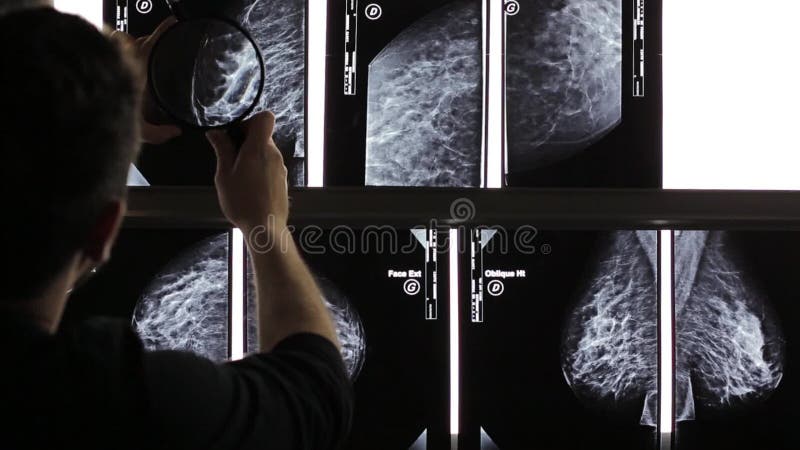 Mammogram X Ray Analysis
