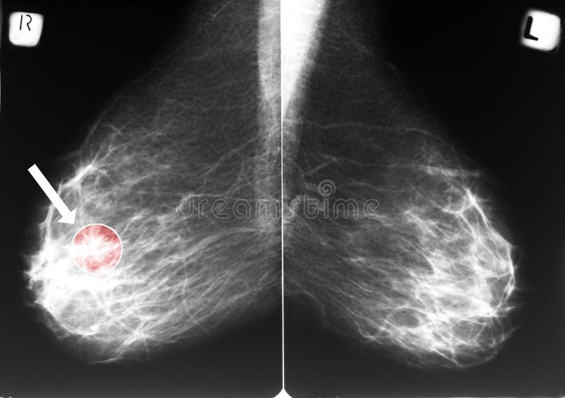 Mammogramma con cancro al seno
