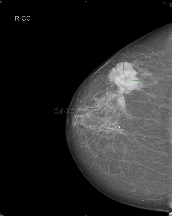 Mammographie bild angezeigt brüste krebs.