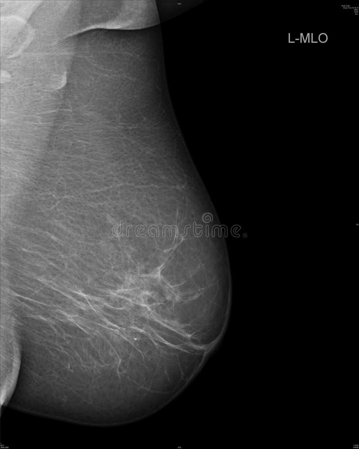 Mammografia immagine da una donna.