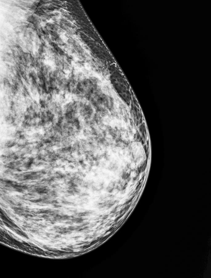 Mammography, x-ray of Breast. Mammography, x-ray of Breast.