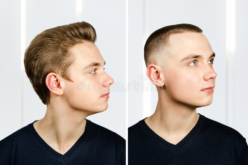 Portrait Young Man Arter Haircut Hair Loss Bald Pompadour Transplant