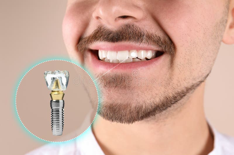 Man with beautiful smile after dental implant installation procedure on beige background, closeup stock photo