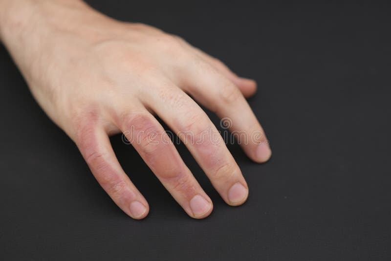 Man With Burn On Her Hand Closeup Burn Blister On The Hand Stock