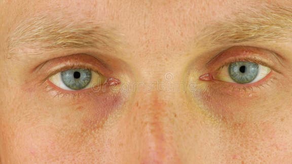 Man Eyes Obstructive Jaundice Yellow Discoloration Real People Liver  Dysfunction Icteruswith Cirrhosis Hepatitis Symptom Stock Video - Video of  anemia, cancer: 220328121