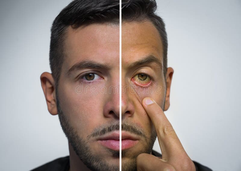 Man Face Divided into Two Parts One Healthy and One Unhealthy. Alcohol  Harm. Stock Image - Image of abnormal, healthy: 207685363