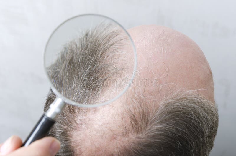 Man Has a Problem with Hair of Searching for Solution To Stop Hair Loss Stock Photo - Image of magnifuing, hair: 143794242 Man Has a Problem with Hair of Searching for Solution To Stop Hair Loss Stock Photo - Image of magnifuing, hair: 143794242