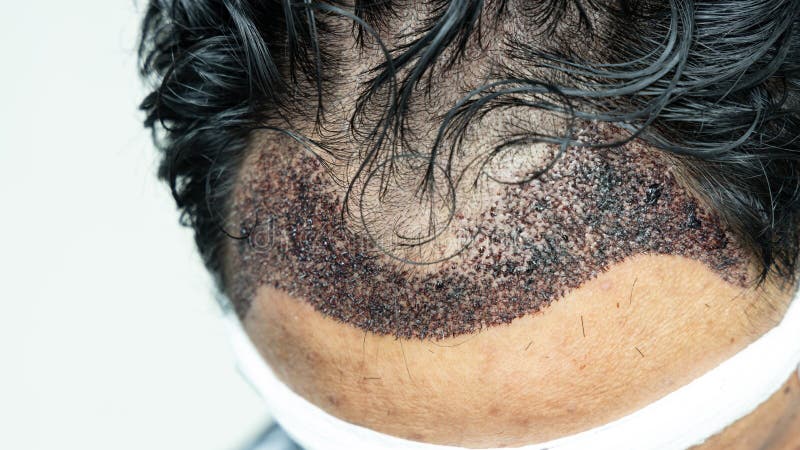 Man Head with Hair Transplant Surgery with Receding Hair Line, FUE,  Follicular Unit Extraction, Types of Hair Transplant Stock Photo - Image of  detail, growth: 194204848