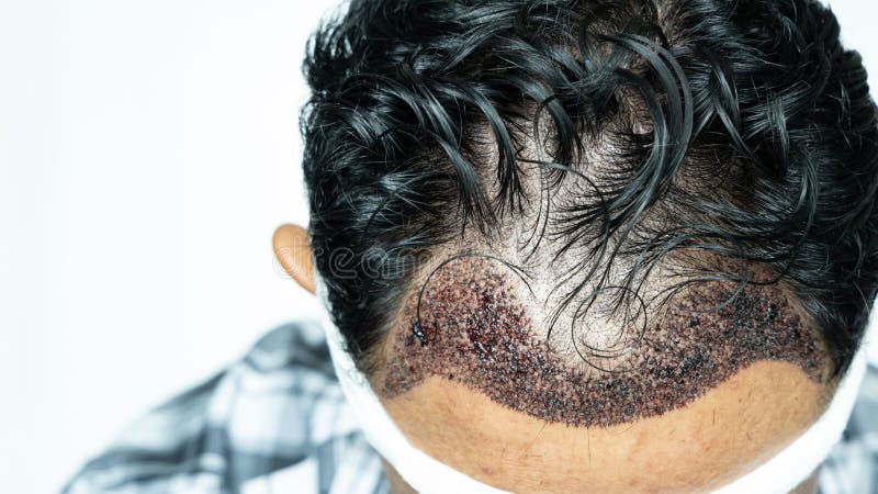 Man Head with Hair Transplant Surgery with Receding Hair Line, FUE,  Follicular Unit Extraction, Types of Hair Transplant Stock Photo - Image of  grow, doctor: 194204854
