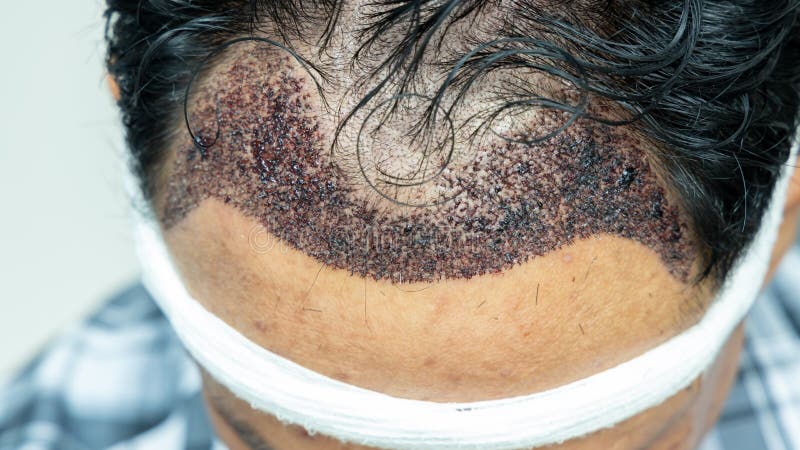 Hair Transplant Fue Stock Photos - Free & Royalty-Free Stock Photos from Dreamstime Hair Transplant Fue Stock Photos - Free & Royalty-Free Stock Photos from Dreamstime