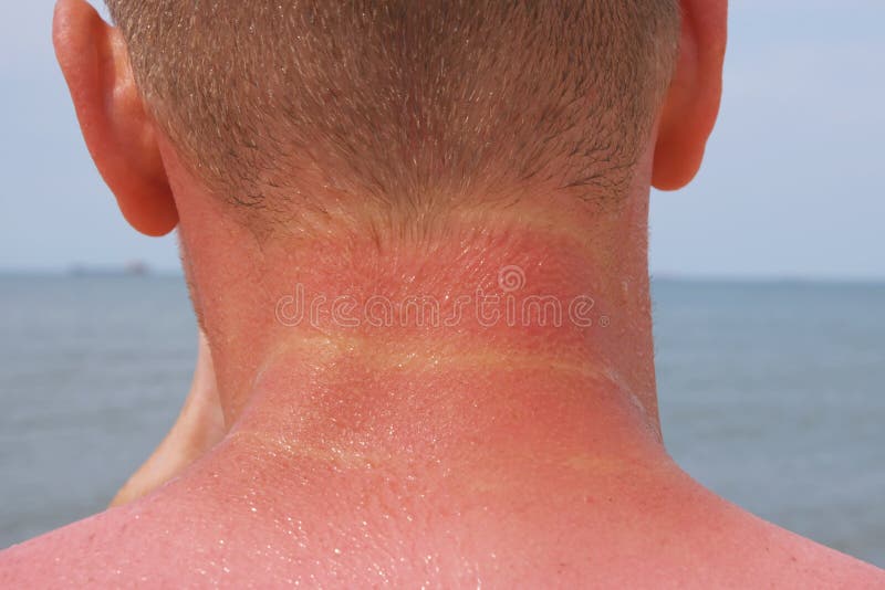 The man received sunburn on seashore. The skin peels off. Protection of the skin from the sun. The man received sunburn on the seashore. The skin peels off