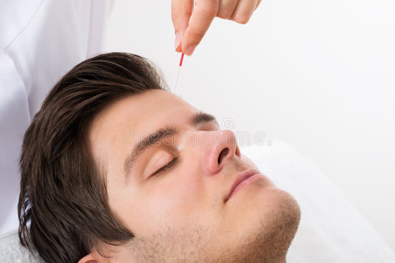 Man Receiving Acupuncture Treatment Stock Image Image of