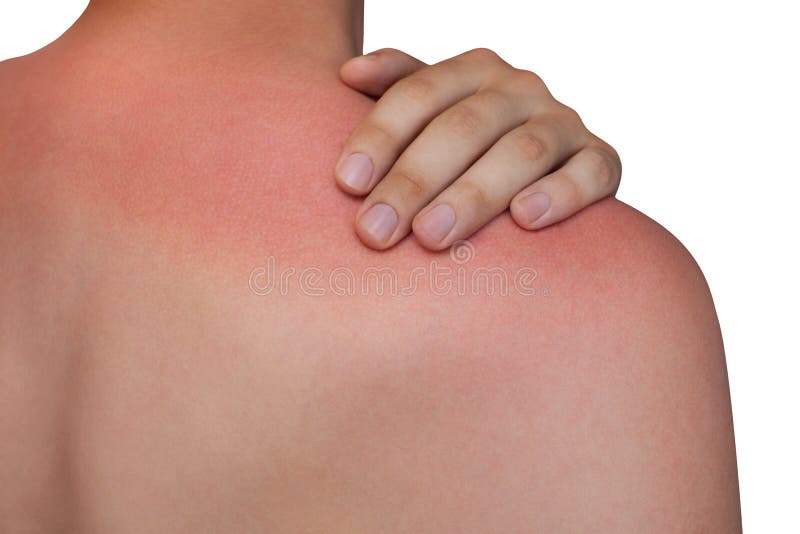 Man with reddened, itchy skin after sunburn on white isolated background