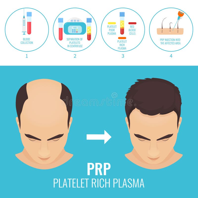 Hair Regrowth Stock Illustrations – 92 Hair Regrowth Stock Illustrations, Vectors & Clipart - Dreamstime Hair Regrowth Stock Illustrations – 92 Hair Regrowth Stock Illustrations, Vectors & Clipart - Dreamstime