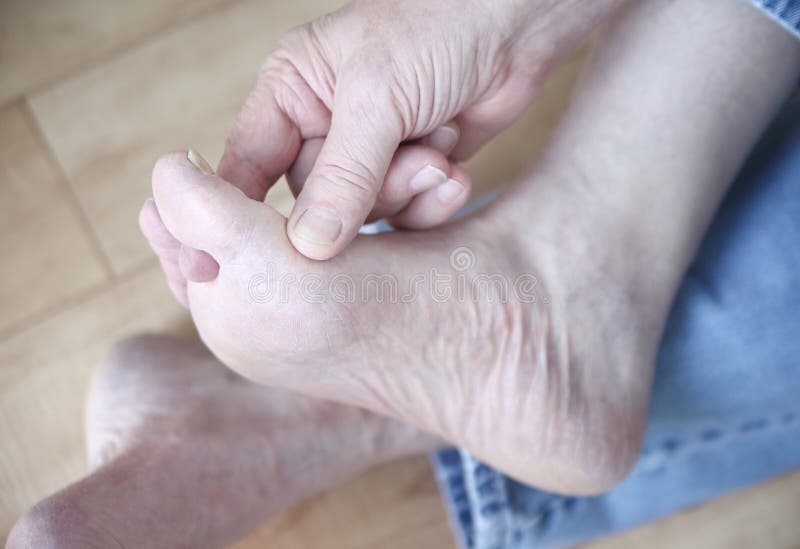 Man Rubbing His Athletes Foot Stock Image Image Of Fungal Fingers