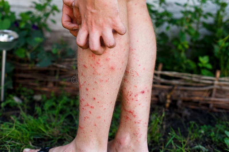 Man scratch the itch with hand, Leg, itching, Concept with Healthcare And Medicine. Mosquito bumps