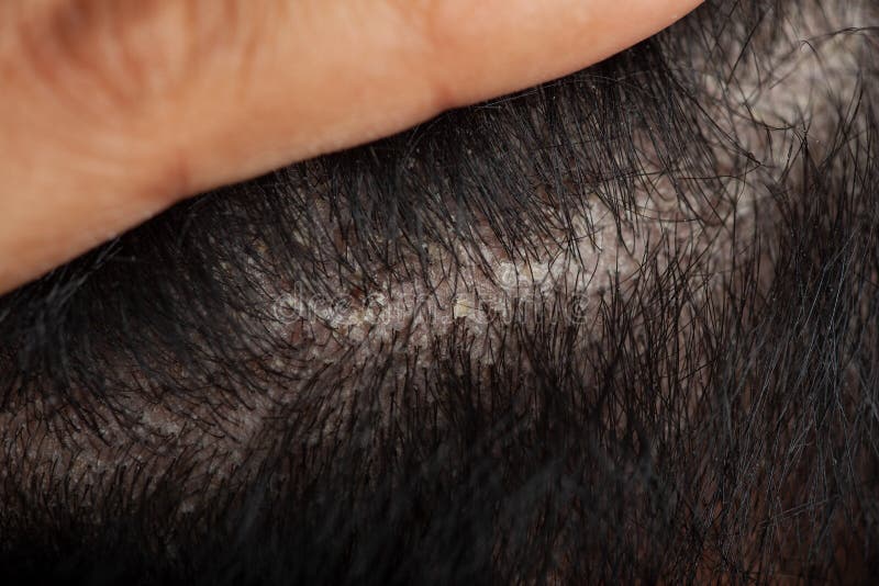 Man Hair Line Showing Hair Root with Dandruff Stock Photo - Image of adults, back: 241780646 Man Hair Line Showing Hair Root with Dandruff Stock Photo - Image of adults, back: 241780646