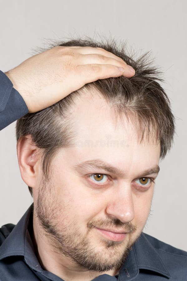 The Man Shows a High Forehead with Receding Hairline. Baldness in Men, Hair  Care. Stock Image - Image of adult, hairstyle: 216840933