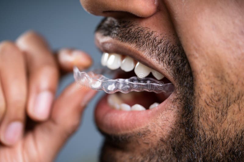 Close-up Of A Man`s Hand Putting Transparent Aligner In Teeth. Close-up Of A Man`s Hand Putting Transparent Aligner In Teeth