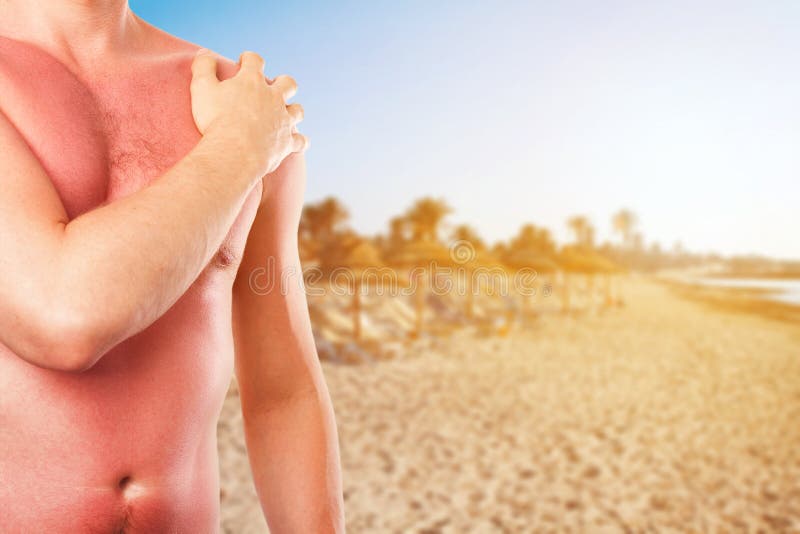 Man with sunburned skin from the sun on the beach