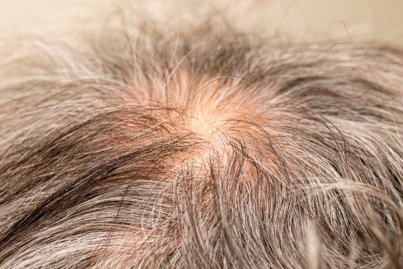 Man with Thinning Hair on the Back of His Head Around the Crown Stock ...