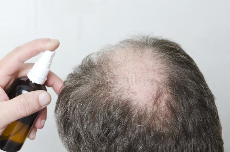 Man Using Cosmetics for Hair Growth of Beauty Treatment To Solve the Problem of Lossing Hair Stock Photo - Image of caucasian, health: 143793986 Man Using Cosmetics for Hair Growth of Beauty Treatment To Solve the Problem of Lossing Hair Stock Photo - Image of caucasian, health: 143793986