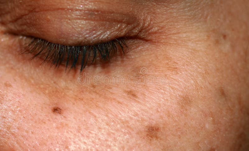 Brown spots on the face. Pigmentation on the skin. Brown age spots on the cheek. Brown spots on the face. Pigmentation on the skin. Brown age spots on the cheek