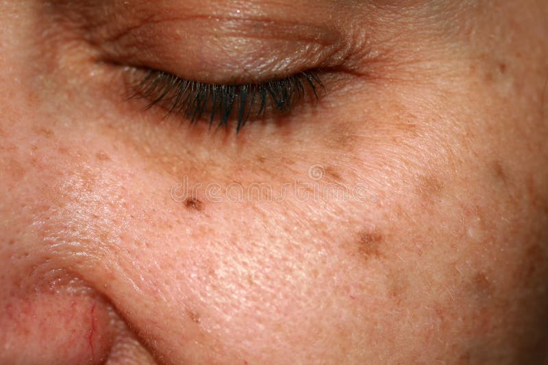 Brown spots on the face. Pigmentation on the skin. Brown age spots on the cheek. Brown spots on the face. Pigmentation on the skin. Brown age spots on the cheek