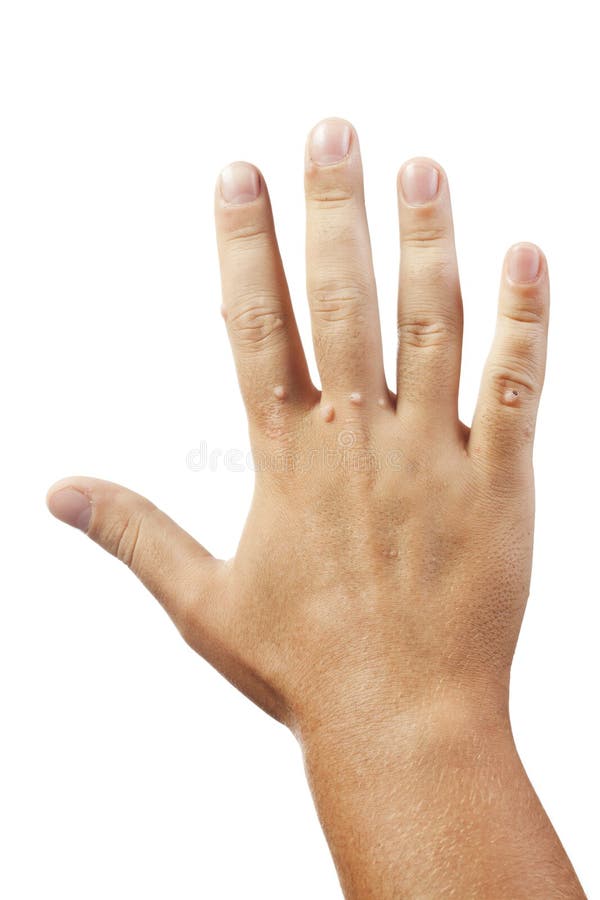 Mano con le verruche isolate su bianco fotografie stock Mano con le verruche isolate su bianco fotografie stock