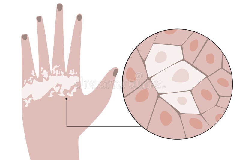 Mano Con Vitiligo Y Estructura De Las Células La Piel Como Concepto Para Problemas De Melanina Lisa Vectorial Con P Stock ilustración - Ilustración terapia, tratamiento: 182450620