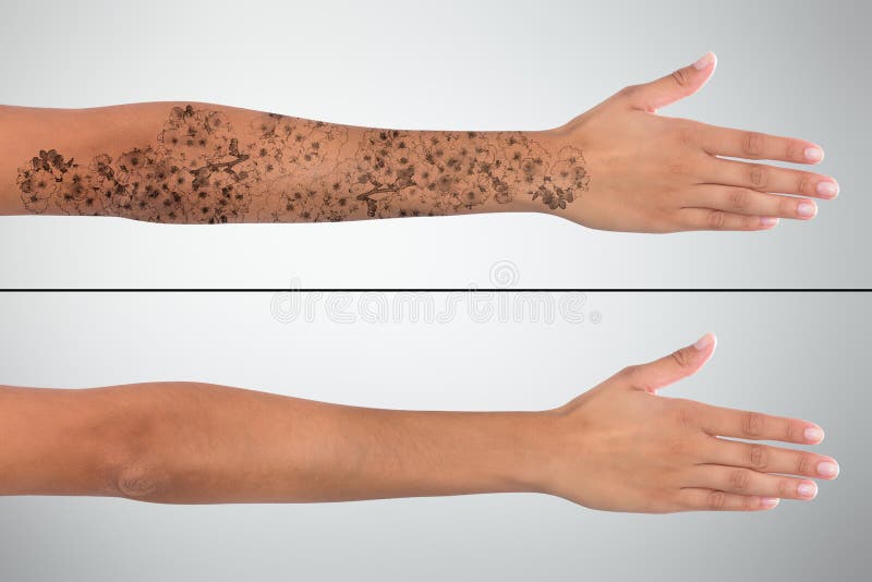 Mano del ` s della donna prima e dopo rimozione del tatuaggio del laser