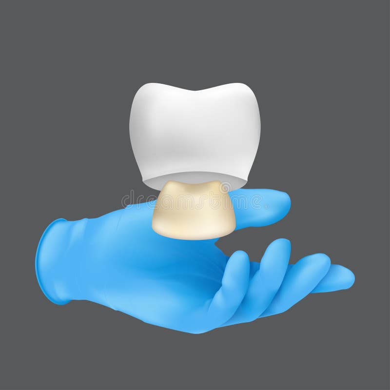 Dentist hand wearing blue protective surgical glove holding a ceramic model of the tooth. 3d realistic vector illustration of a crown on teeth concept isolated on a grey background. Dentist hand wearing blue protective surgical glove holding a ceramic model of the tooth. 3d realistic vector illustration of a crown on teeth concept isolated on a grey background