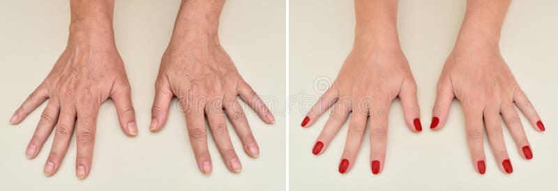 Manos de una mujer antes y después del tratamiento de la manicura y de la piel imágenes de archivo libres de regalías Manos de una mujer antes y después del tratamiento de la manicura y de la piel imágenes de archivo libres de regalías