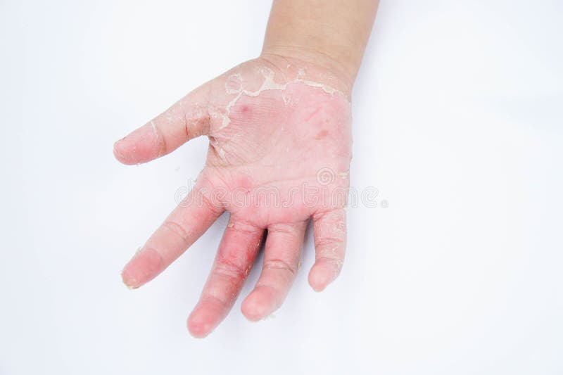 Manos secas, cáscara, dermatitis de contacto, infecciones por hongos, piel inf imagenes de archivo Manos secas, cáscara, dermatitis de contacto, infecciones por hongos, piel inf imagenes de archivo