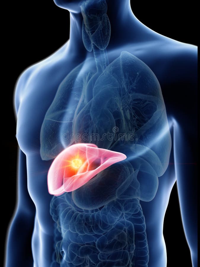 Liver tumor stock illustration. Illustration of graphic - 23711056